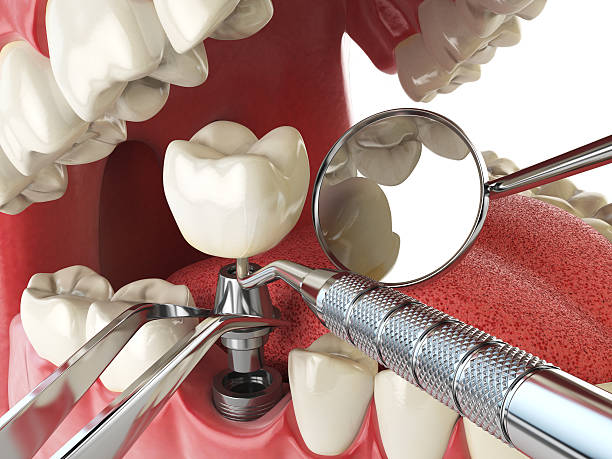 Best Emergency Treatment for Toothache in Pineville, NC